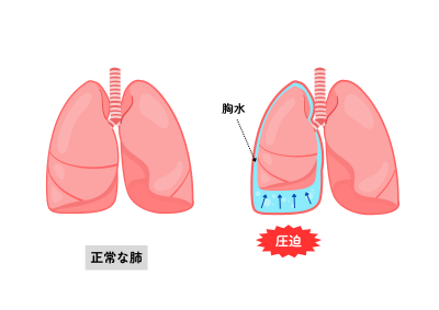 正常な肺と、胸水がたまって肺が圧迫されている状態を比較したイラスト